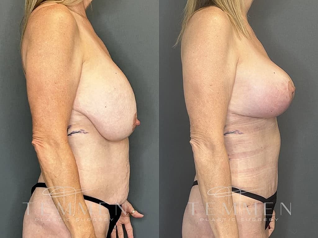 Before and after plastic surgery transformation.