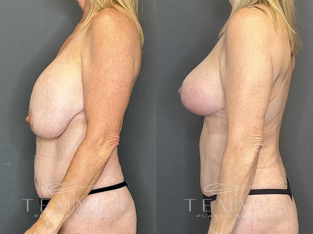 Before and after breast enhancement procedure comparison.