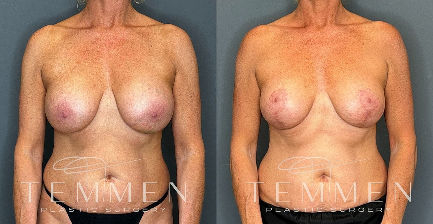 Before and after breast augmentation results