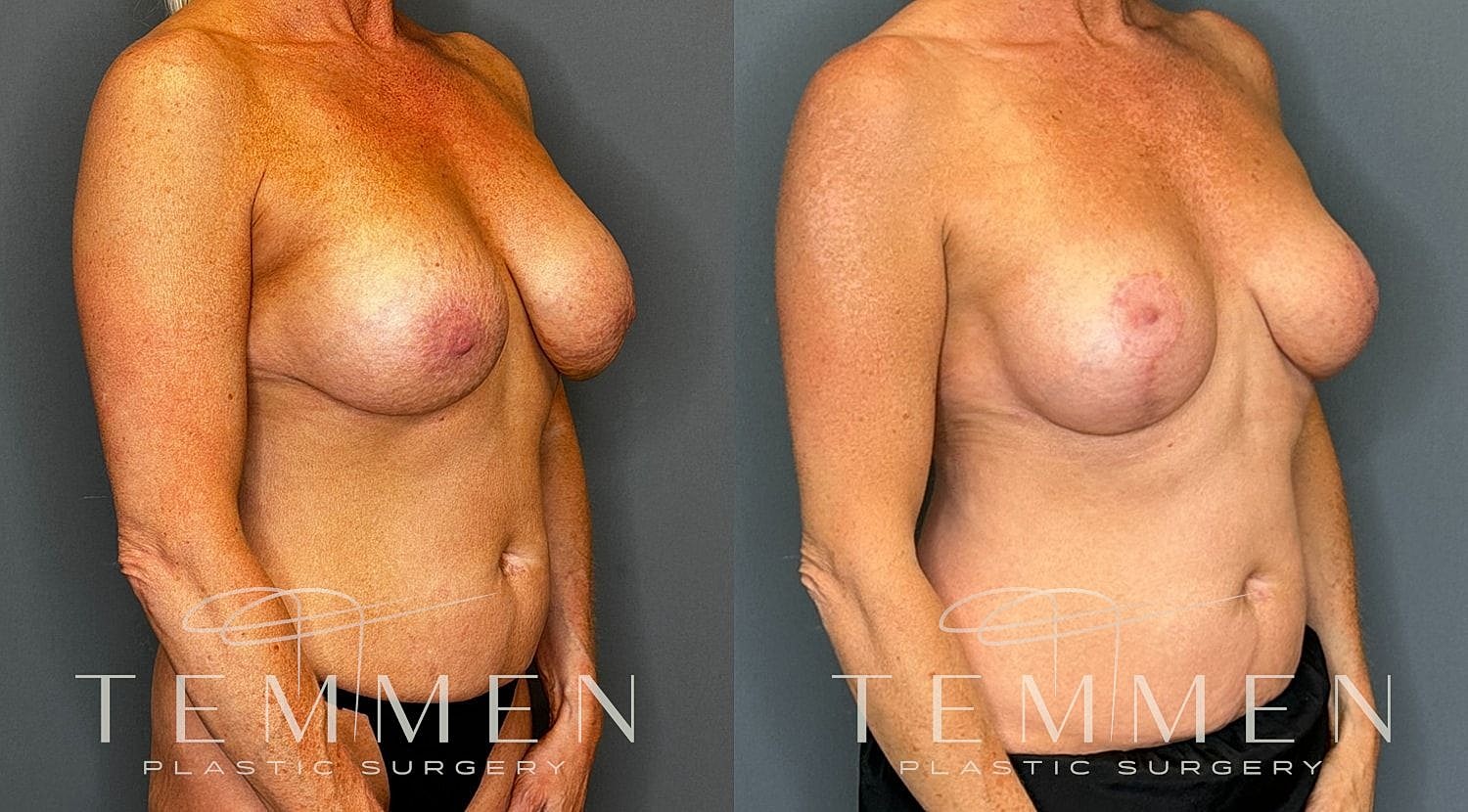 Before and after breast augmentation results.