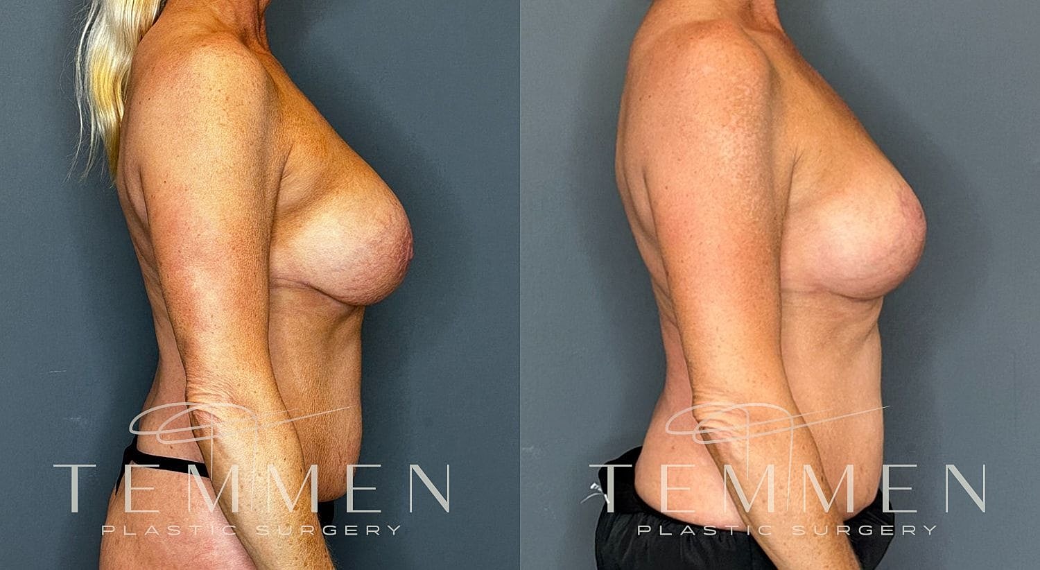 Before and after side profile of breast procedure.