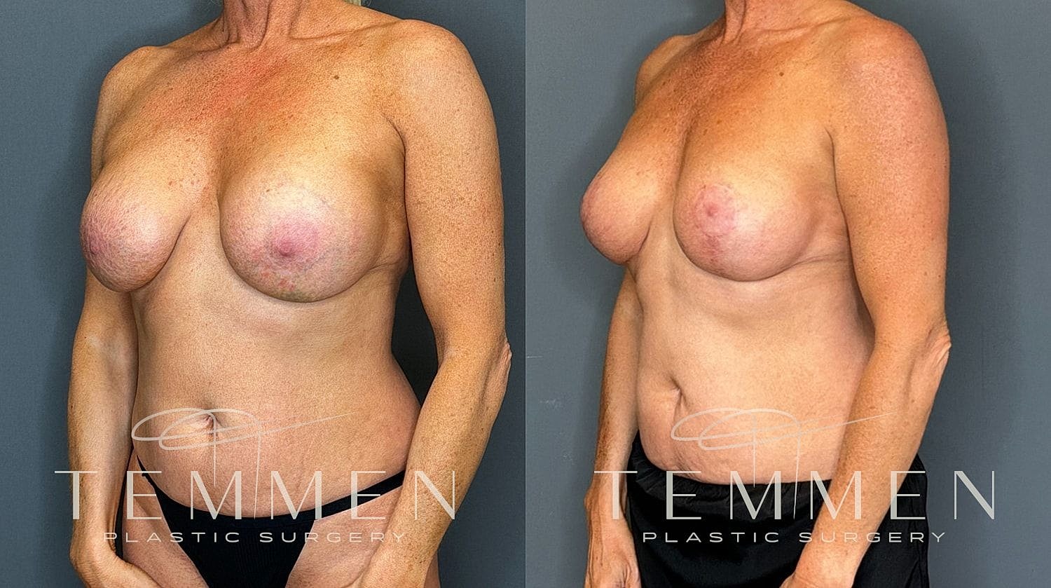 Before and after breast augmentation comparison photo.