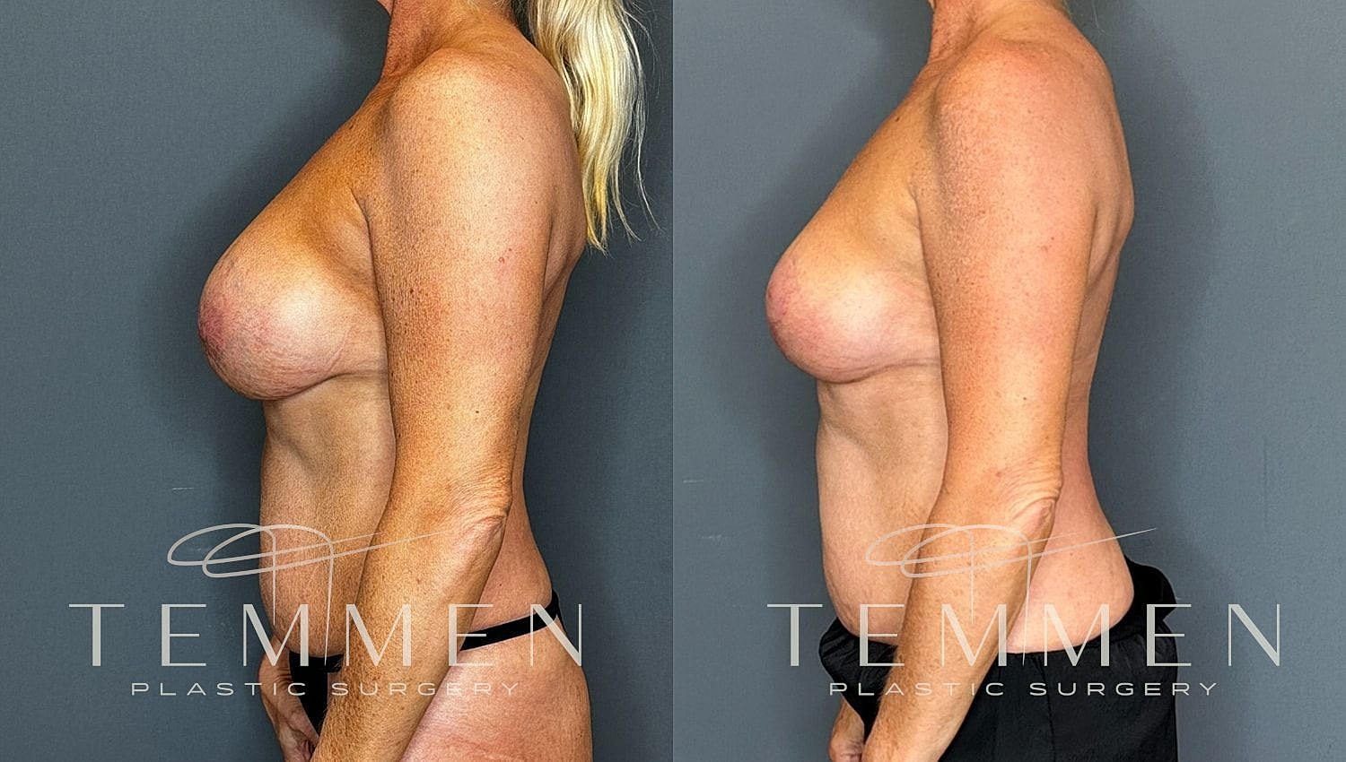Before and after plastic surgery comparison image.