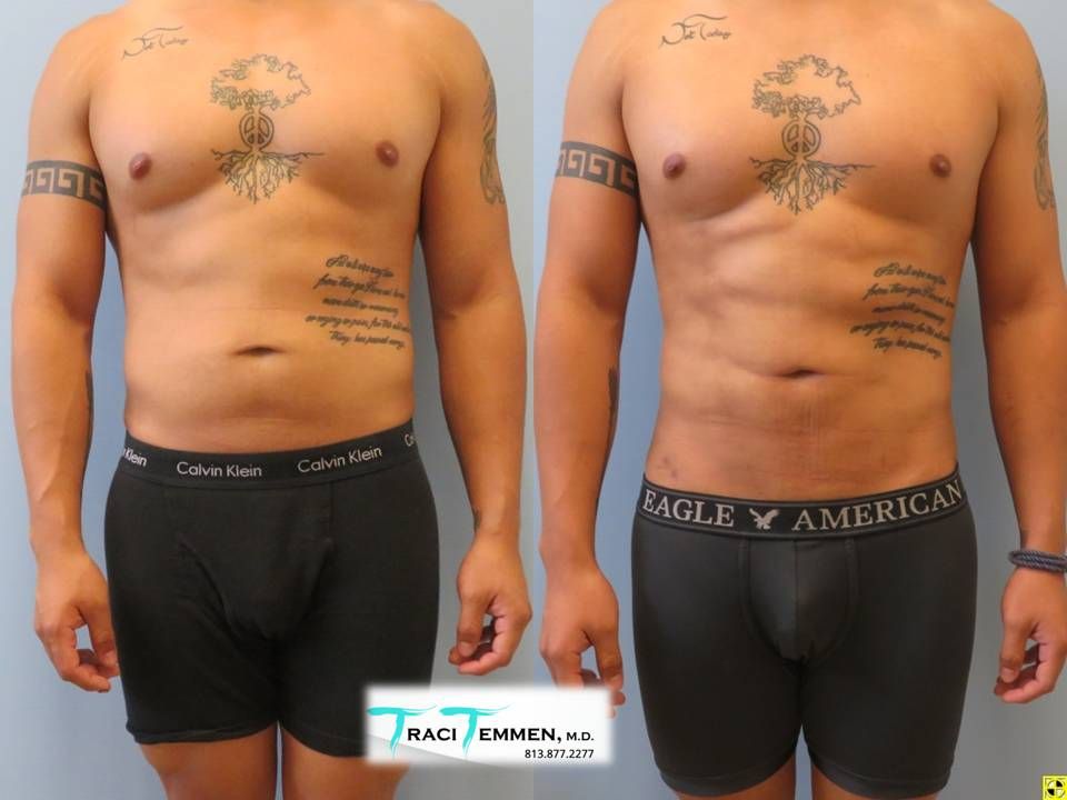 Male Lipoetching Before & After