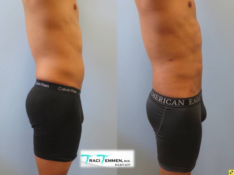 Male Lipoetching Before & After