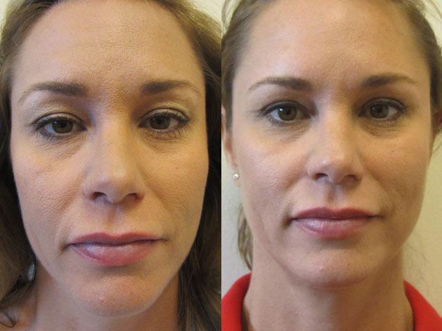 Eyelid Surgery Before & After