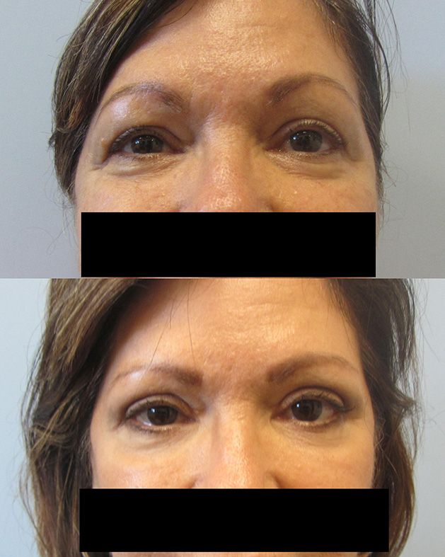 Eyelid Surgery Before & After