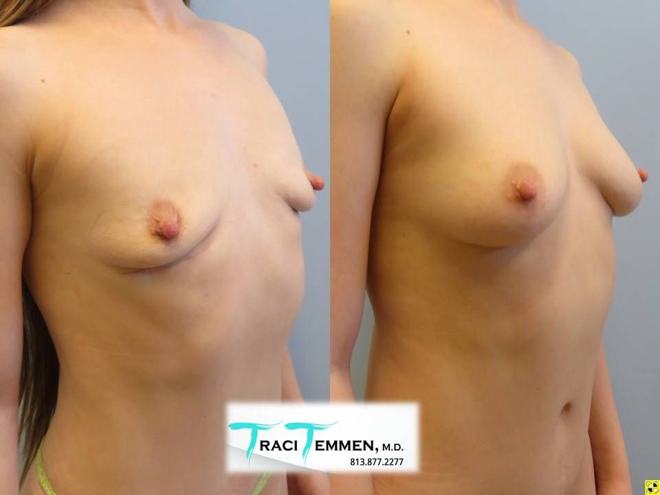 Natural Breast Augmentation Before & After