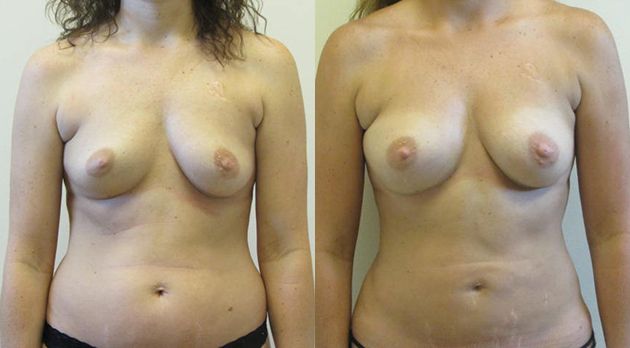 Natural Breast Augmentation Before & After