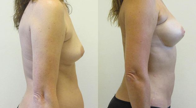 Natural Breast Augmentation Before & After