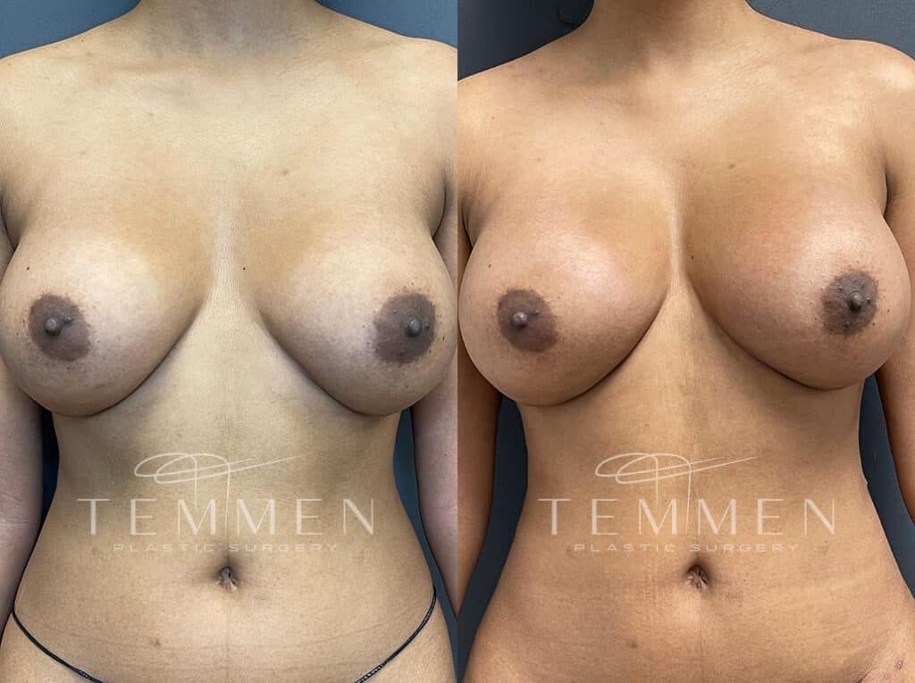 Natural Breast Augmentation Before & After