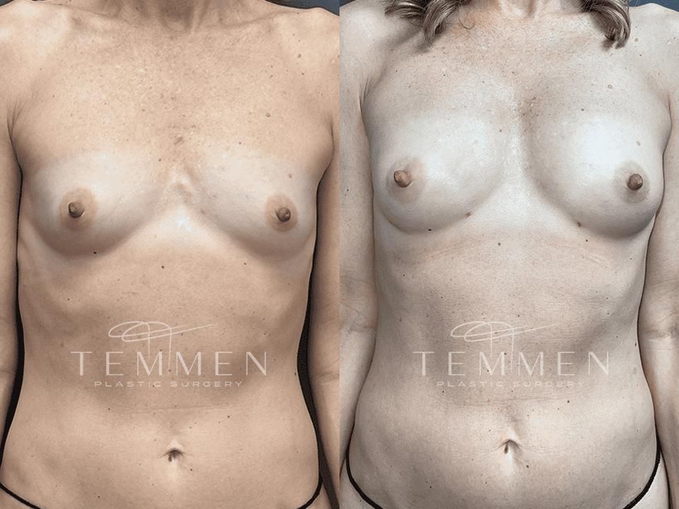 Natural Breast Augmentation Before & After