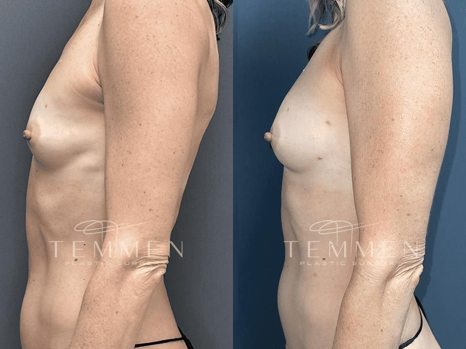 Natural Breast Augmentation Before & After