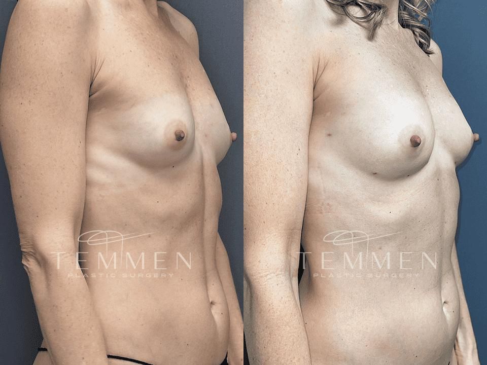 Natural Breast Augmentation Before & After