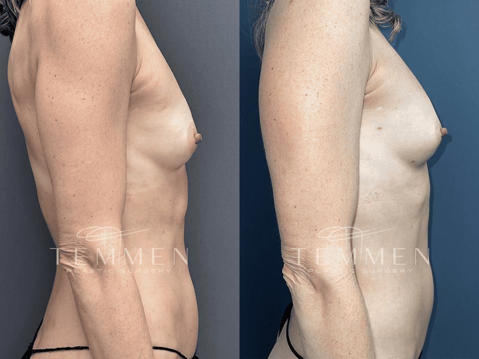 Natural Breast Augmentation Before & After