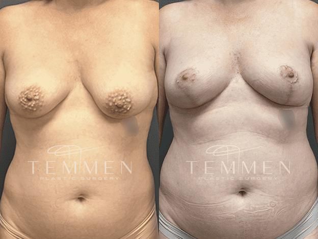 Natural Breast Augmentation Before & After