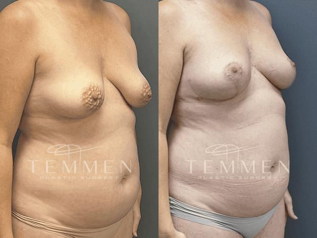 Natural Breast Augmentation Before & After