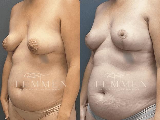 Natural Breast Augmentation Before & After