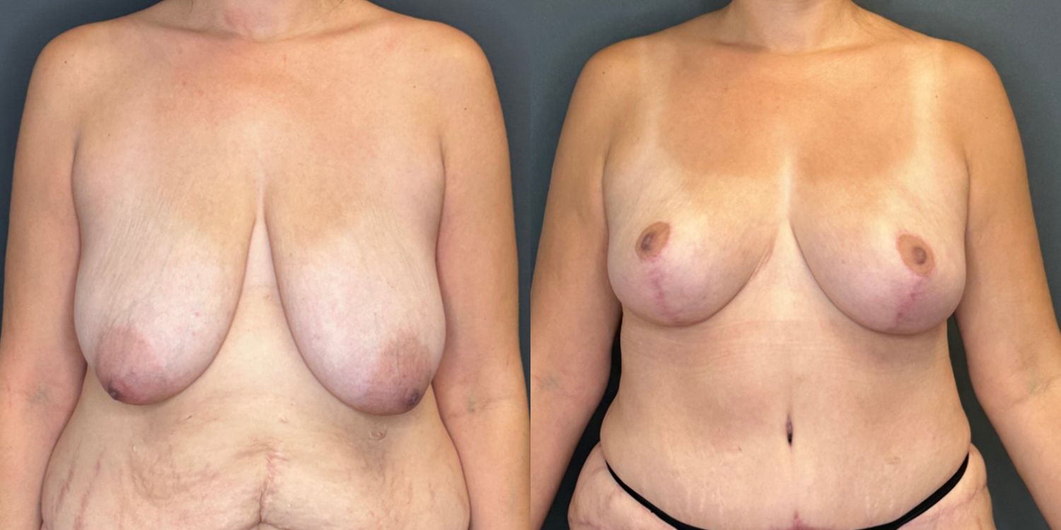 Natural Breast Augmentation Before & After