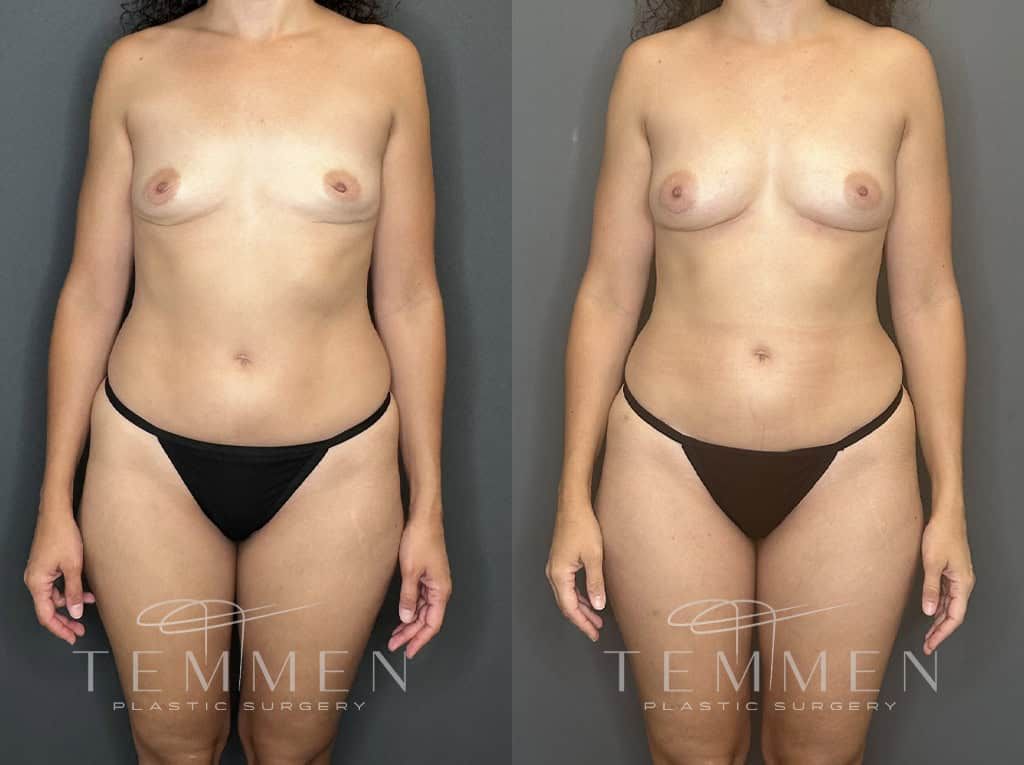 Natural Breast Augmentation Before & After