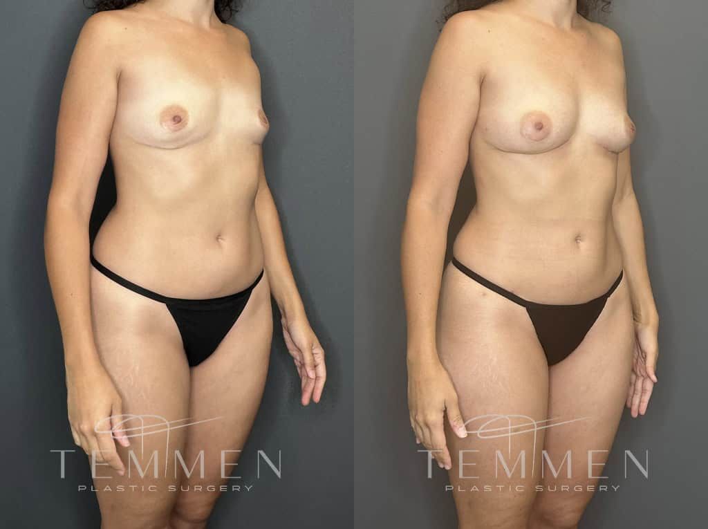 Natural Breast Augmentation Before & After