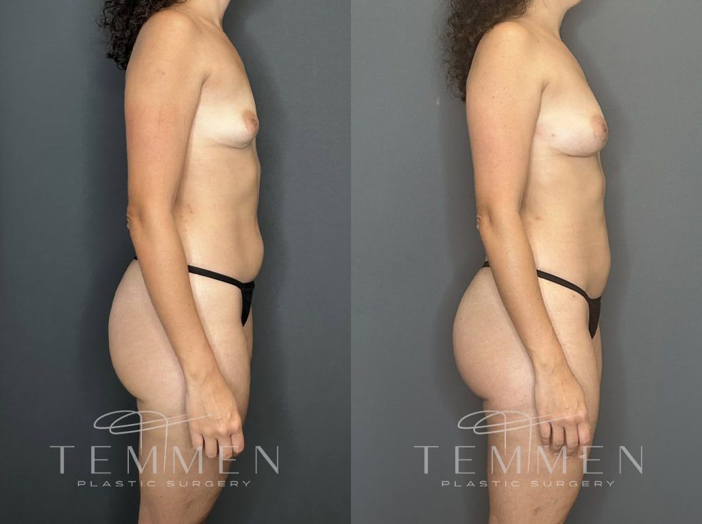 Natural Breast Augmentation Before & After