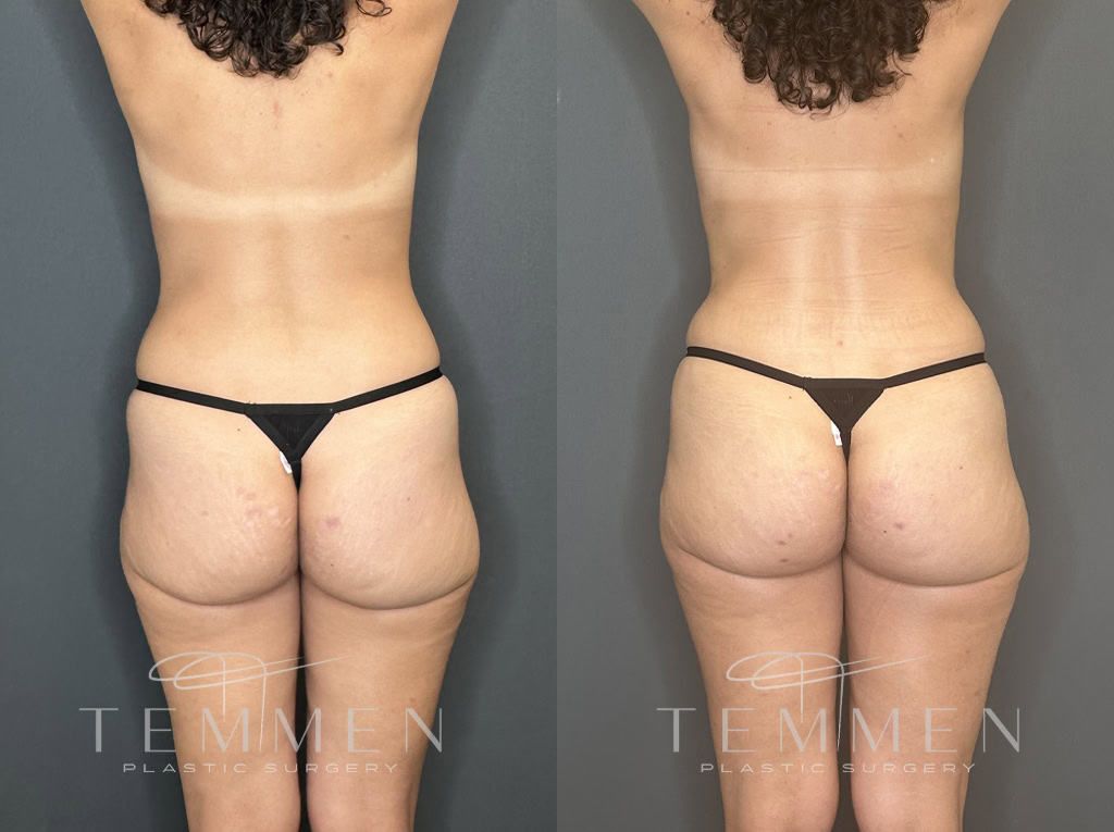 Natural Breast Augmentation Before & After