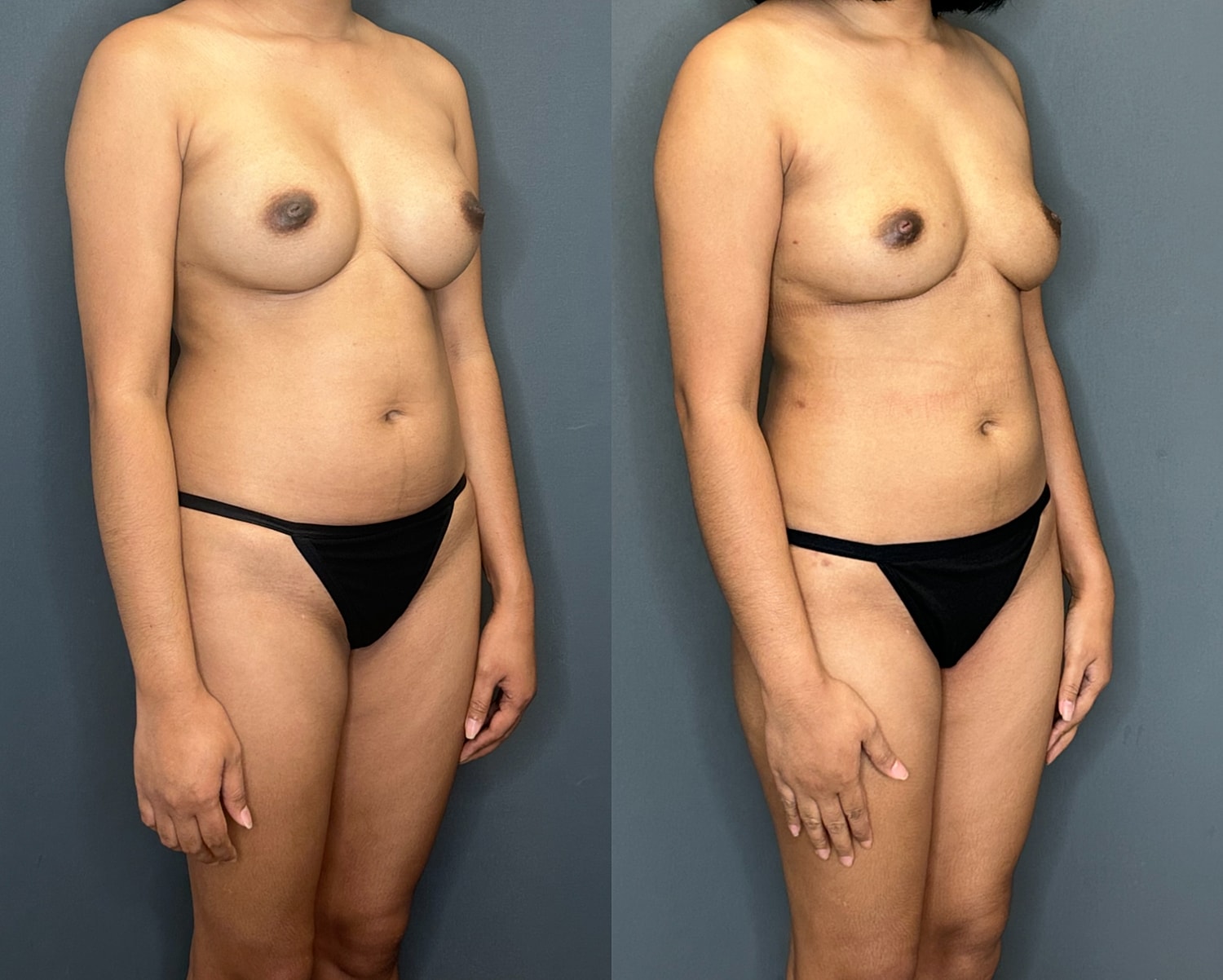 Natural Breast Augmentation Before & After