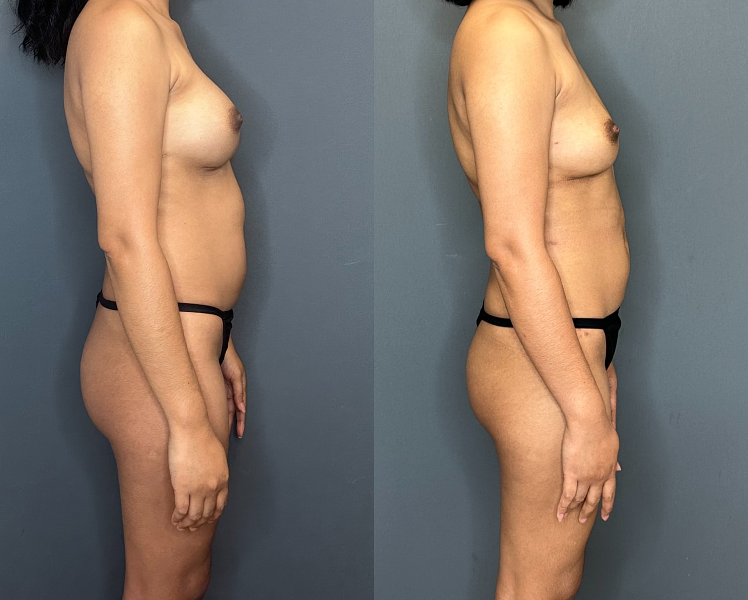 Natural Breast Augmentation Before & After