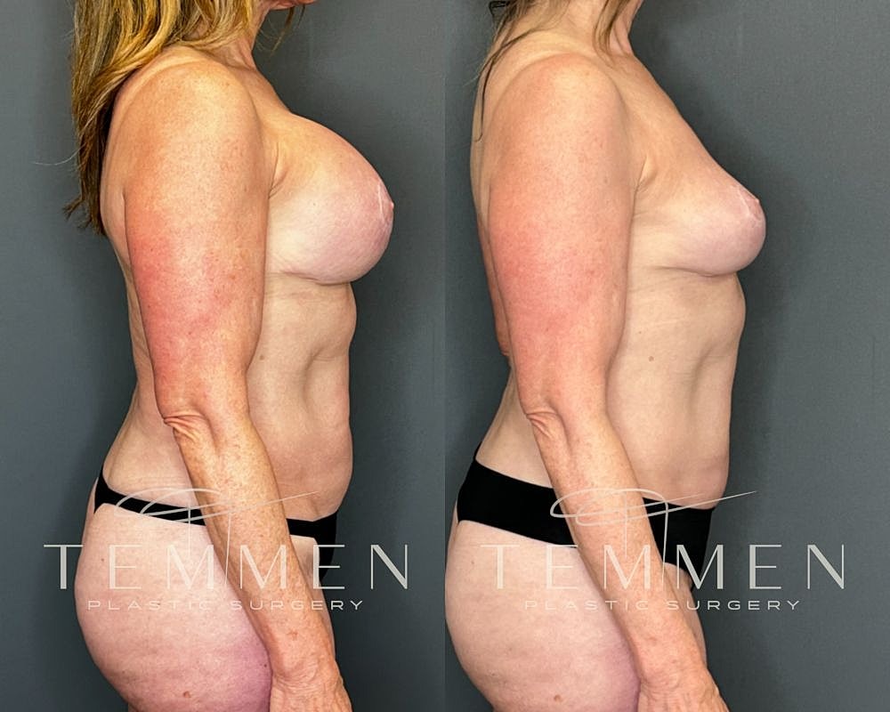 Before and after plastic surgery side view.