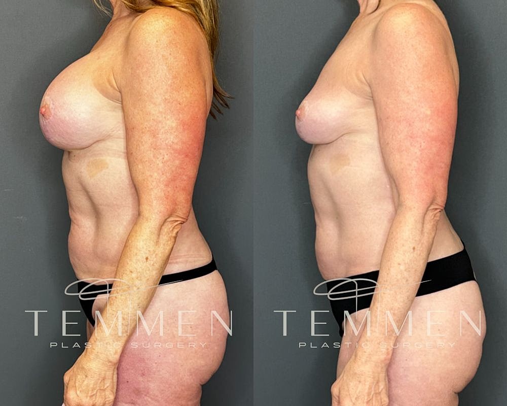 Before and after plastic surgery side profile.