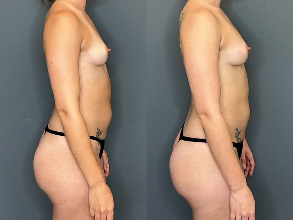 Natural Breast Augmentation Before & After