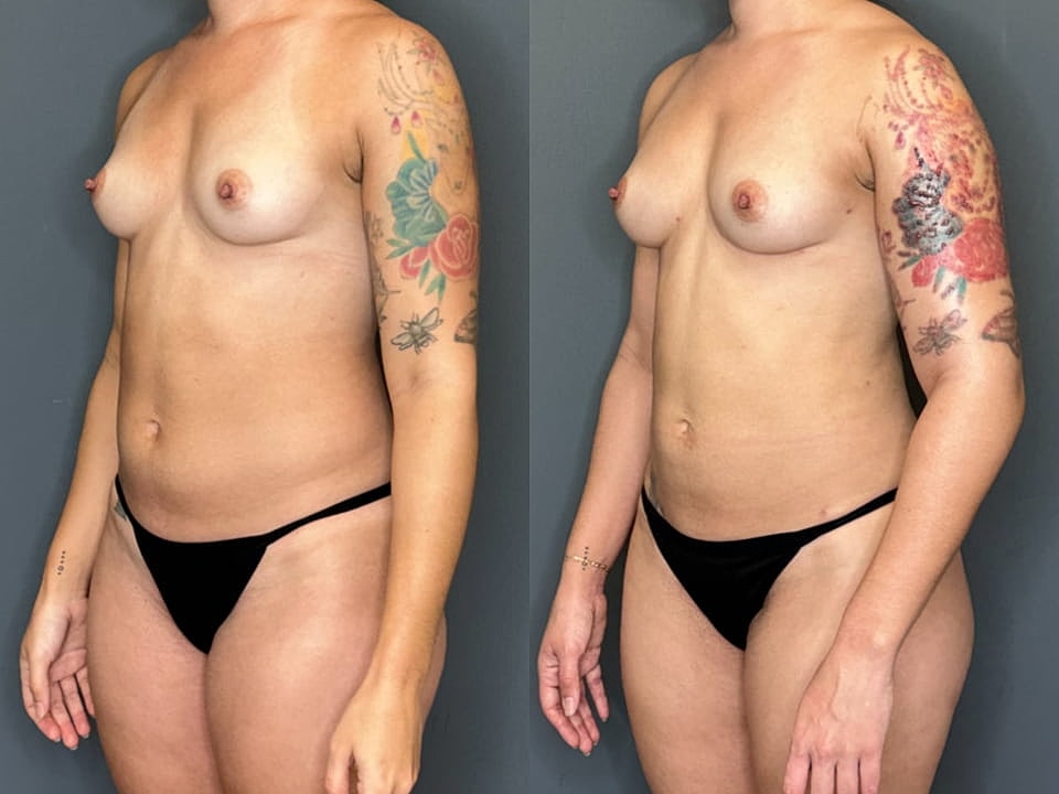 Natural Breast Augmentation Before & After