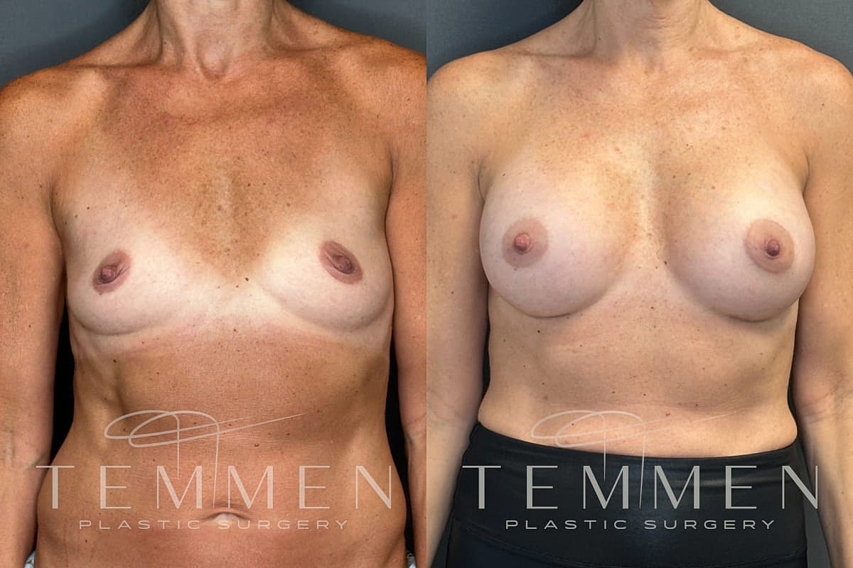 Natural Breast Augmentation Before & After