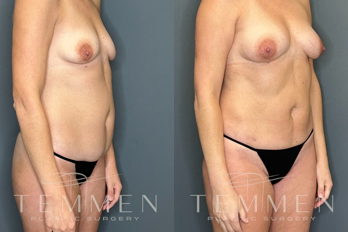 Natural Breast Augmentation Before & After