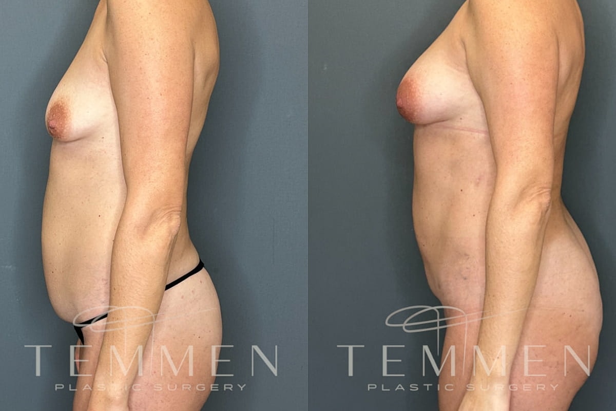 Natural Breast Augmentation Before & After