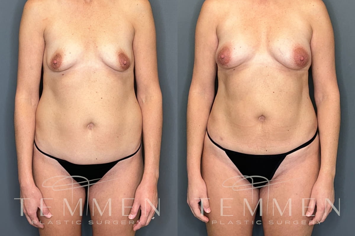 Natural Breast Augmentation Before & After