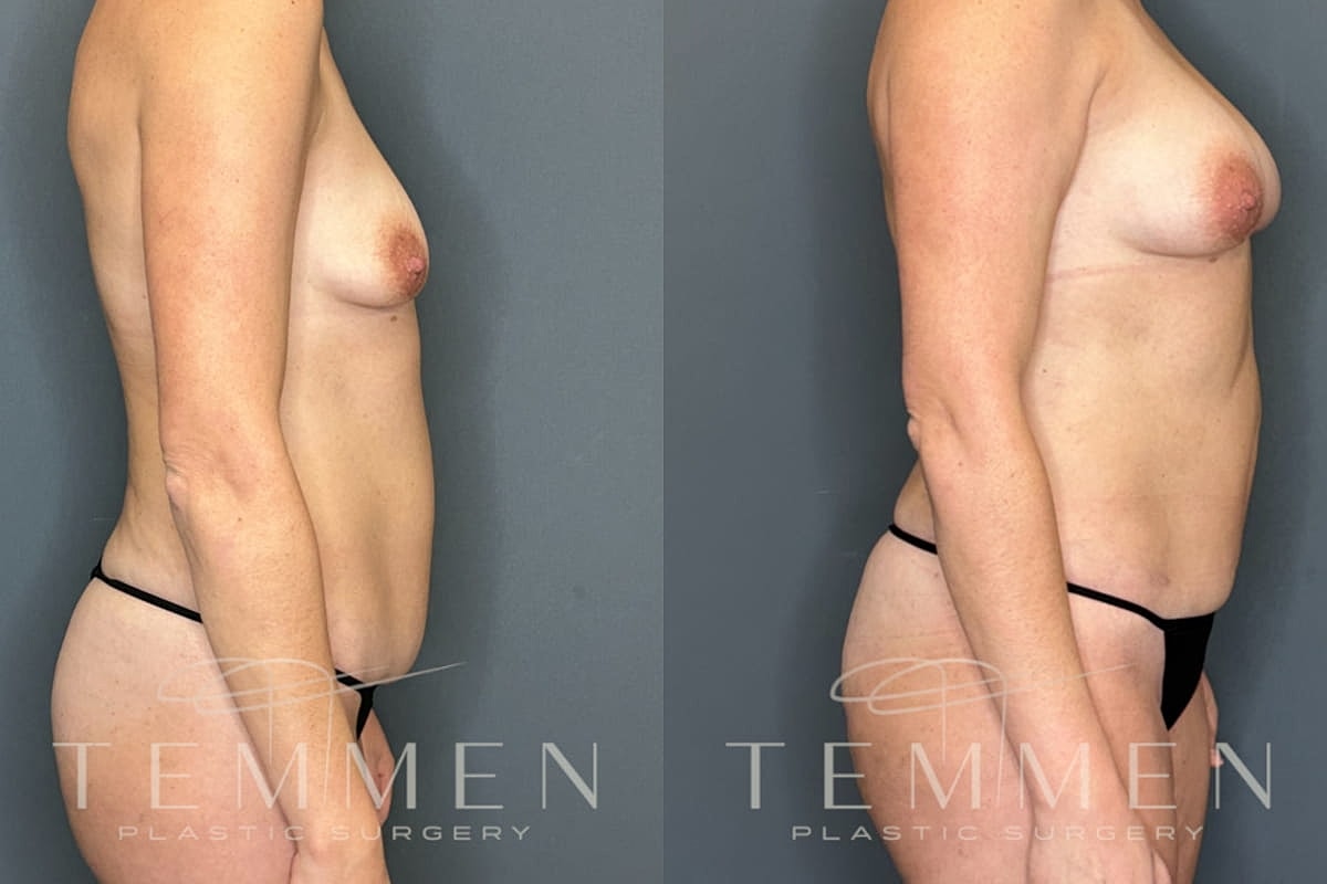 Natural Breast Augmentation Before & After
