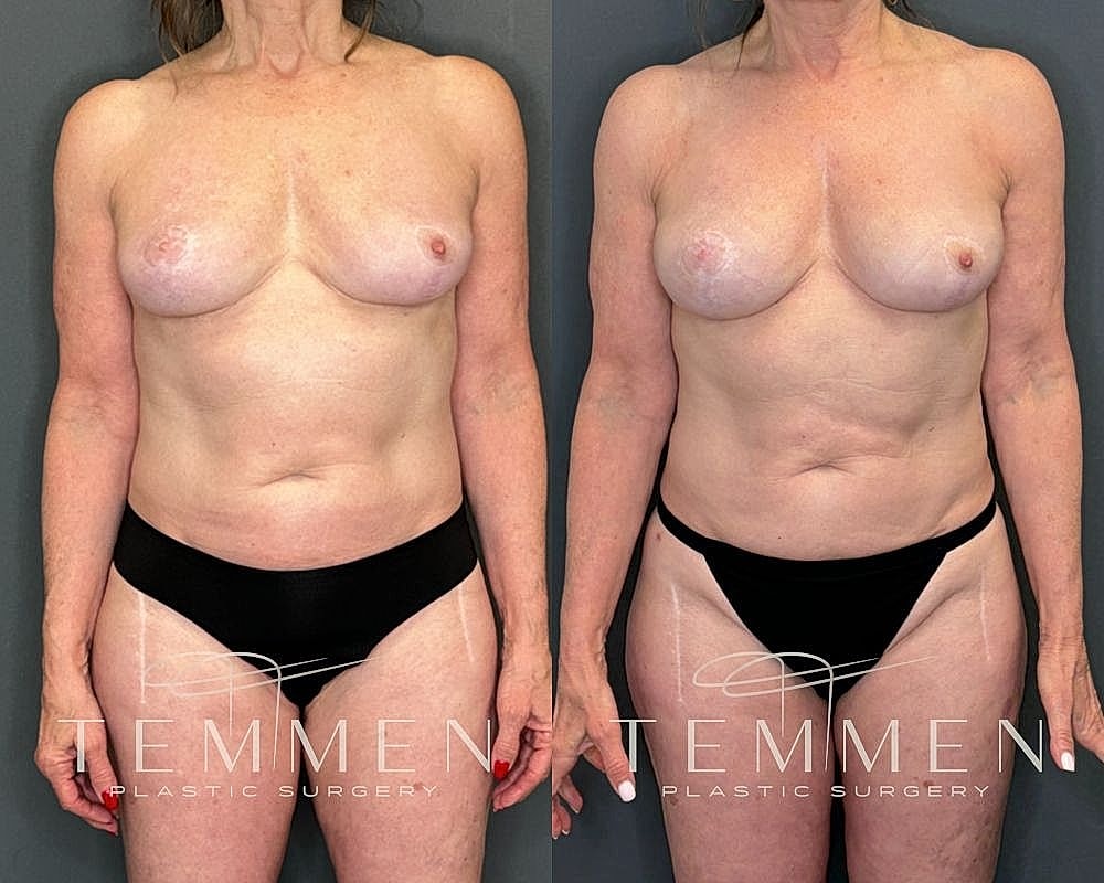 Before and after plastic surgery transformation.