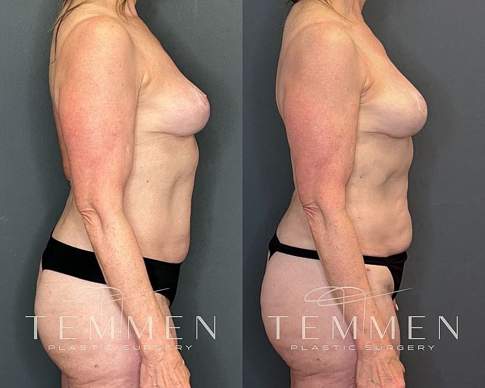 Before and after side profile of body transformation.