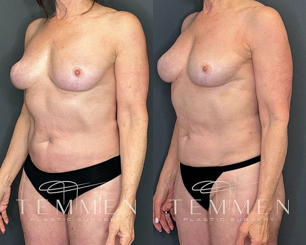 Before and after plastic surgery side view.