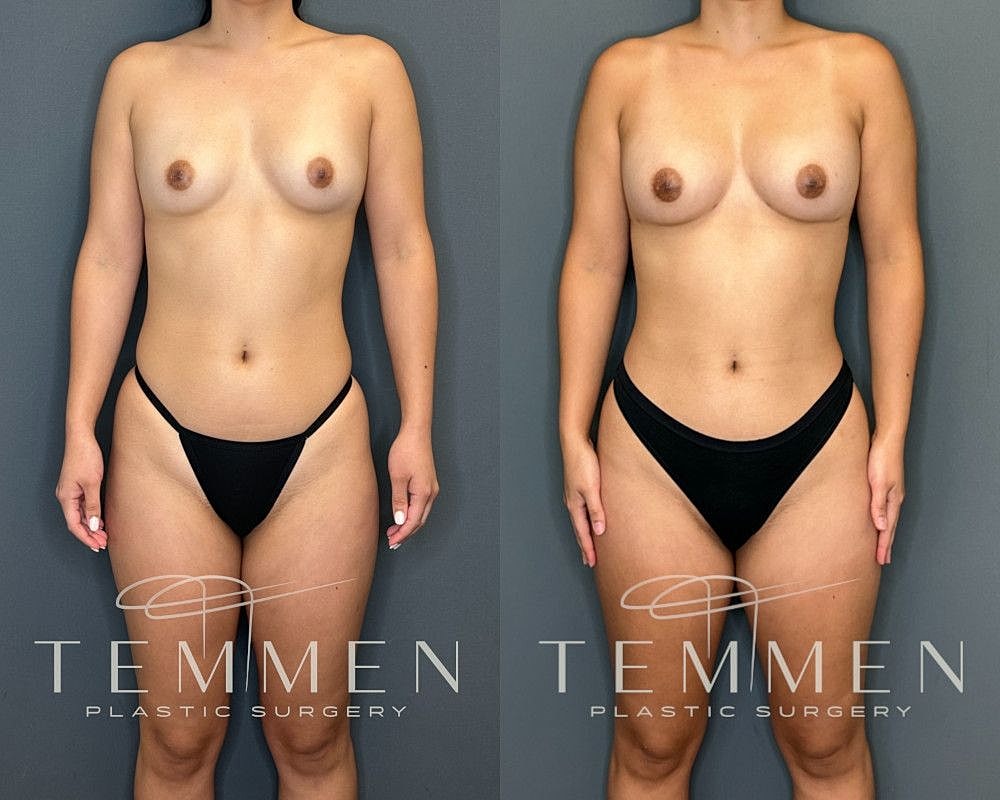 Natural Breast Augmentation Before & After