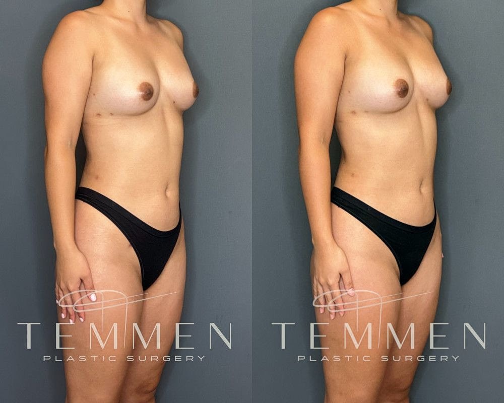 Natural Breast Augmentation Before & After