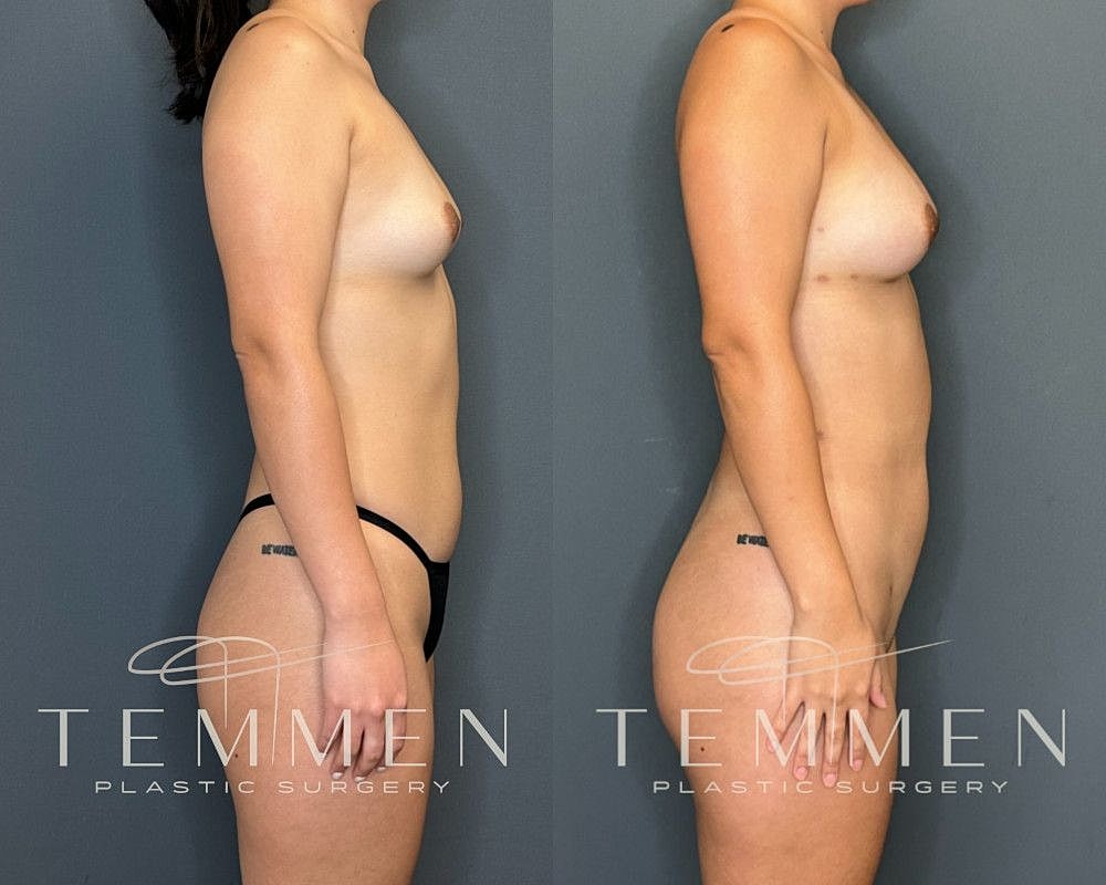 Natural Breast Augmentation Before & After