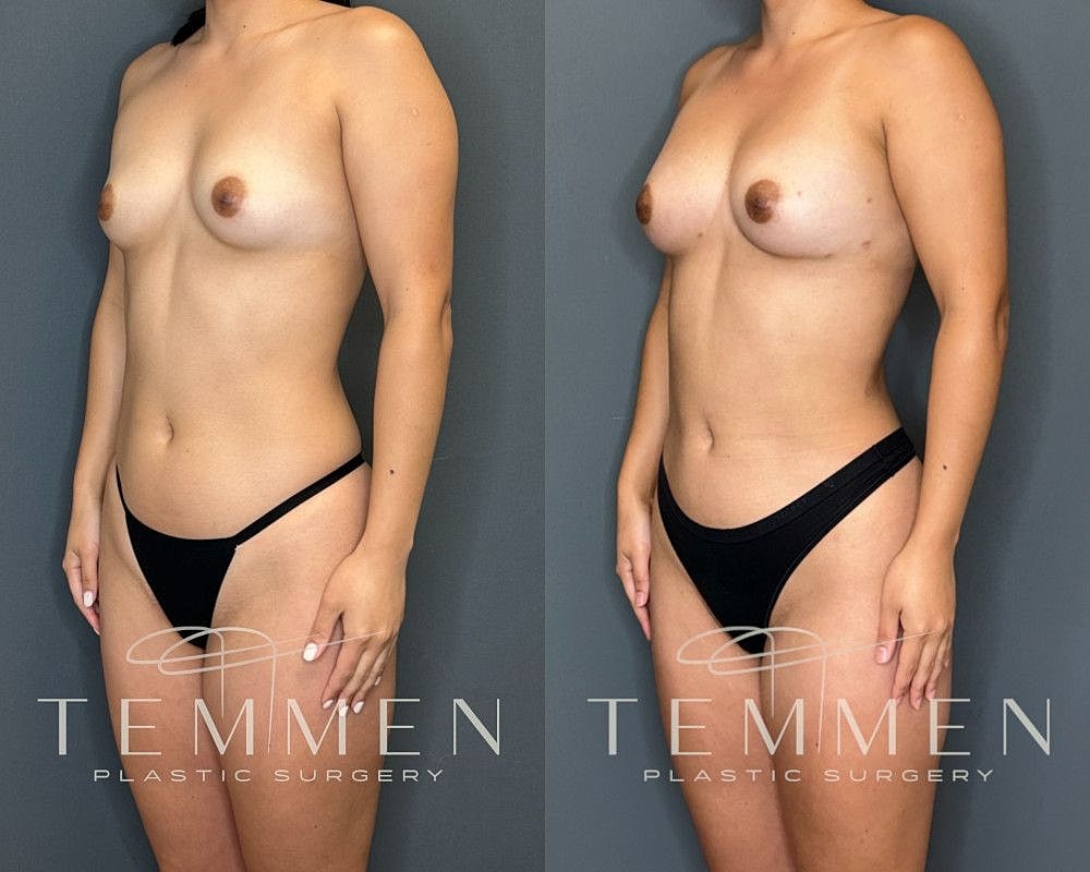 Natural Breast Augmentation Before & After