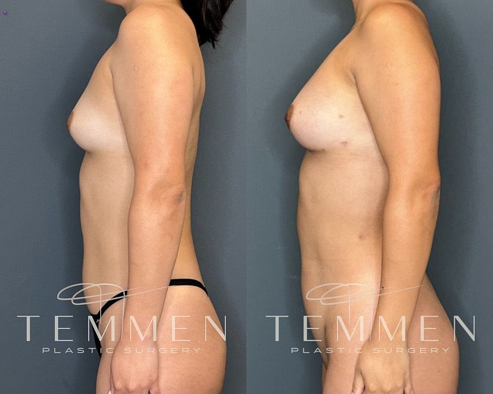 Natural Breast Augmentation Before & After