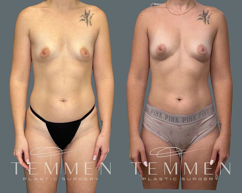 Natural Breast Augmentation Before & After