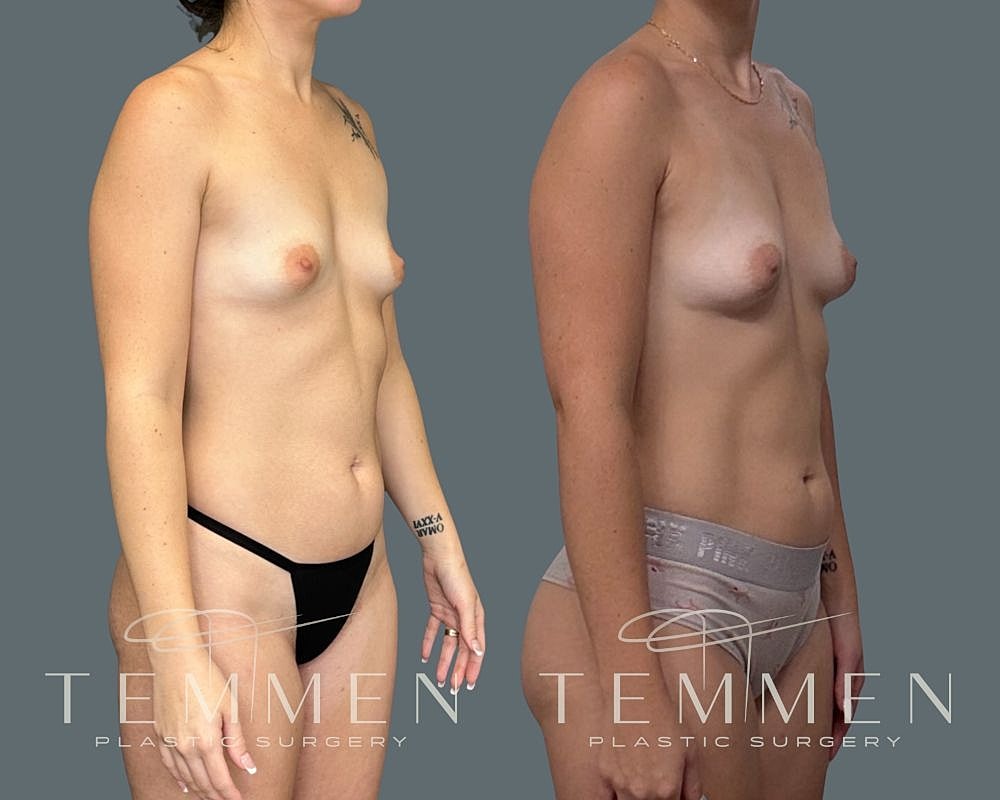 Natural Breast Augmentation Before & After