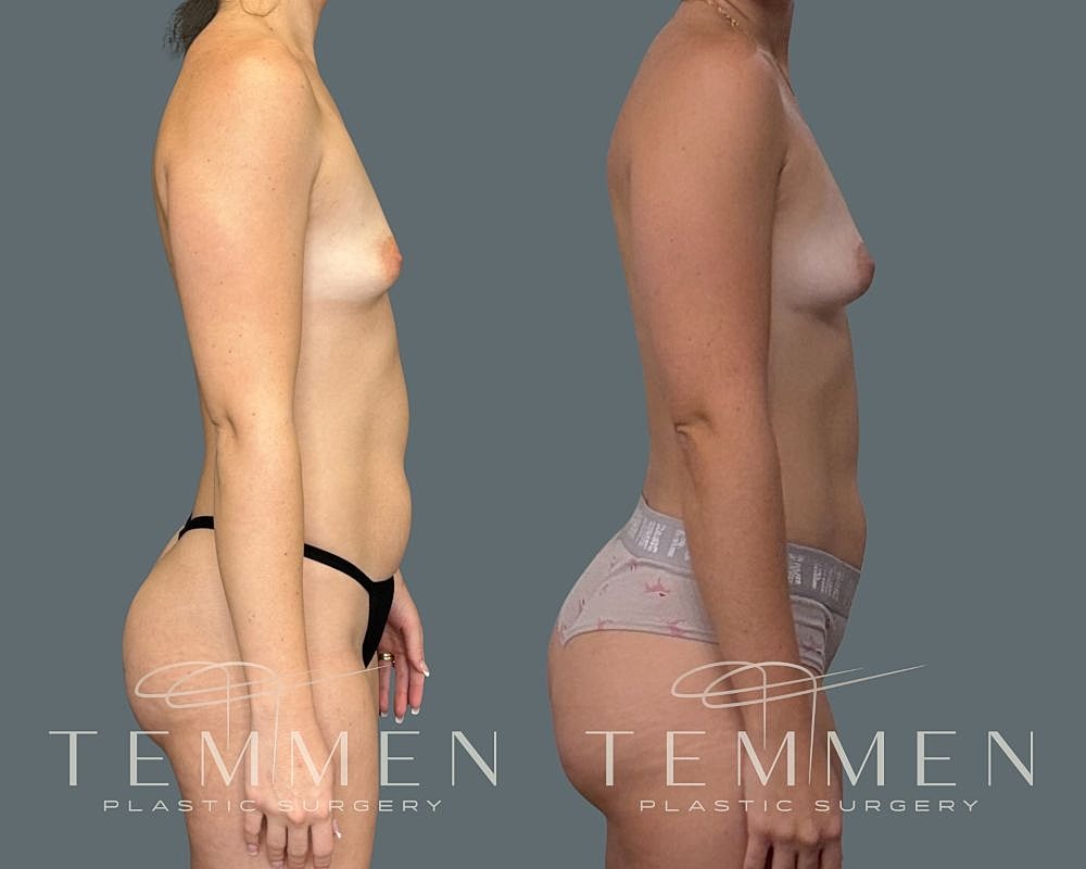 Natural Breast Augmentation Before & After