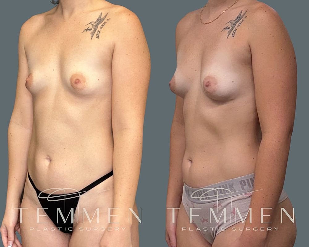 Natural Breast Augmentation Before & After